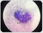 PPP2R1A Gene Mutations Improve ATR Inhibitor Drug Effectiveness in Ovarian Clear Cell Cancers